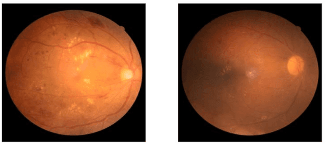 Figure 1 for Progressive Transfer Learning for Multi-Pass Fundus Image Restoration