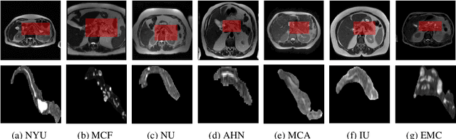 Figure 2 for IPMN Risk Assessment under Federated Learning Paradigm