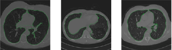 Figure 3 for FusionLungNet: Multi-scale Fusion Convolution with Refinement Network for Lung CT Image Segmentation