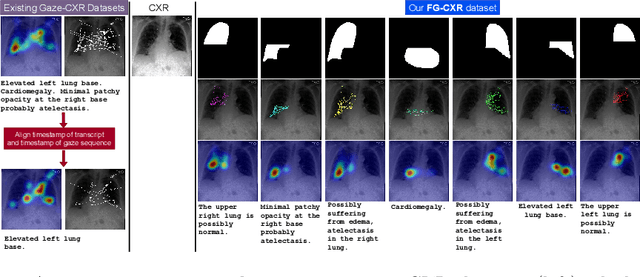 Figure 3 for FG-CXR: A Radiologist-Aligned Gaze Dataset for Enhancing Interpretability in Chest X-Ray Report Generation