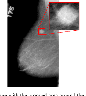 Figure 1 for Integrating AI for Human-Centric Breast Cancer Diagnostics: A Multi-Scale and Multi-View Swin Transformer Framework