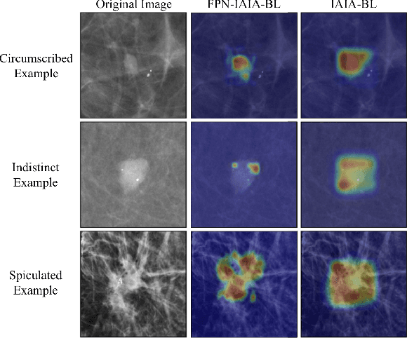 Figure 1 for FPN-IAIA-BL: A Multi-Scale Interpretable Deep Learning Model for Classification of Mass Margins in Digital Mammography