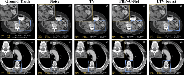 Figure 2 for Learnable Total Variation with Lambda Mapping for Low-Dose CT Denoising