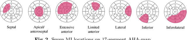 Figure 3 for Influence of Myocardial Infarction on QRS Properties: A Simulation Study