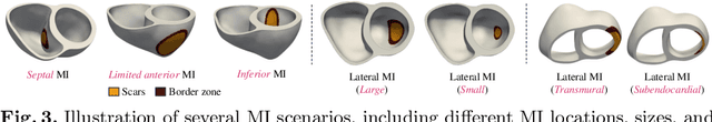 Figure 4 for Influence of Myocardial Infarction on QRS Properties: A Simulation Study