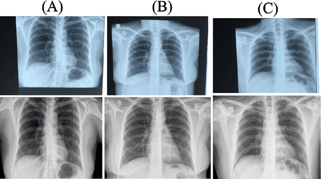 Figure 1 for Comparative Evaluation of Digital and Analog Chest Radiographs to Identify Tuberculosis using Deep Learning Model