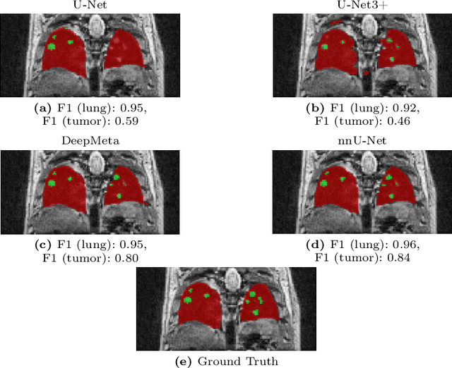 Figure 3 for Lung tumor segmentation in MRI mice scans using 3D nnU-Net with minimum annotations