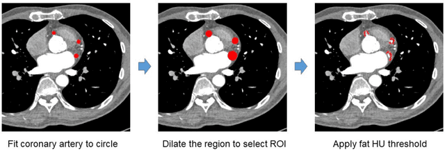 Figure 1 for Pericoronary adipose tissue feature analysis in CT calcium score images with comparison to coronary CTA