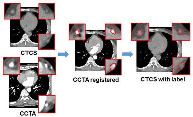 Figure 2 for Pericoronary adipose tissue feature analysis in CT calcium score images with comparison to coronary CTA