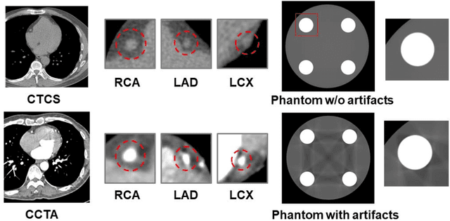 Figure 3 for Pericoronary adipose tissue feature analysis in CT calcium score images with comparison to coronary CTA