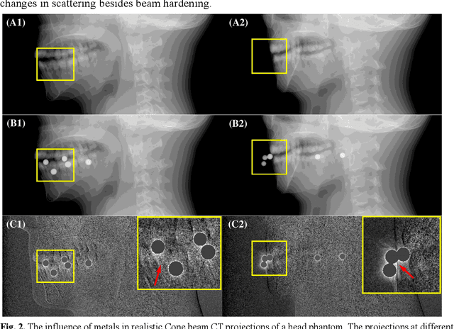 Figure 3 for PND-Net: Physics based Non-local Dual-domain Network for Metal Artifact Reduction