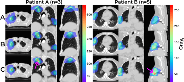 Figure 4 for Latent Spaces Enable Transformer-Based Dose Prediction in Complex Radiotherapy Plans