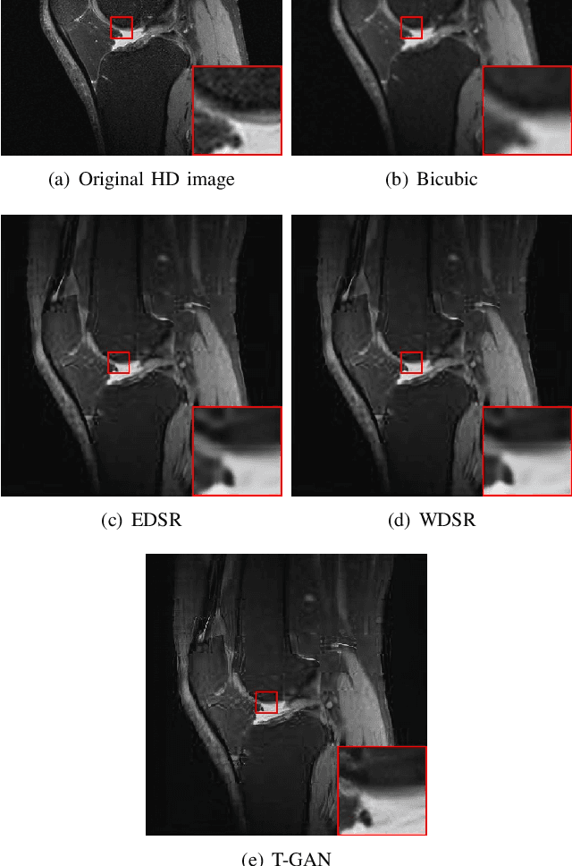 Figure 3 for Transformer and GAN Based Super-Resolution Reconstruction Network for Medical Images