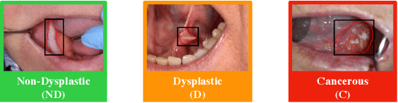 Figure 2 for An Attention Based Pipeline for Identifying Pre-Cancer Lesions in Head and Neck Clinical Images