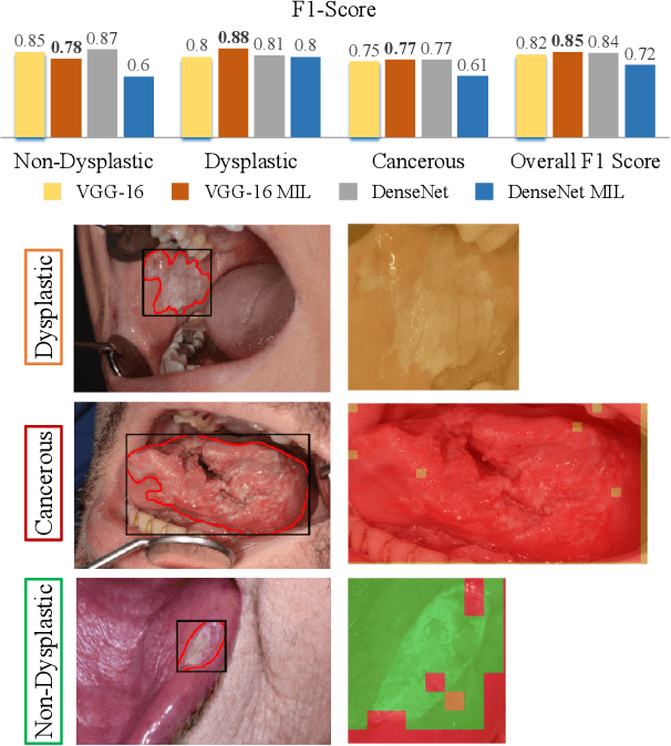 Figure 4 for An Attention Based Pipeline for Identifying Pre-Cancer Lesions in Head and Neck Clinical Images