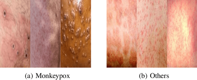 Figure 4 for Attention Based Feature Fusion Network for Monkeypox Skin Lesion Detection