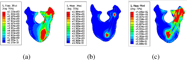 Figure 4 for Towards Biomechanics-Aware Design of a Steerable Drilling Robot for Spinal Fixation Procedures with Flexible Pedicle Screws