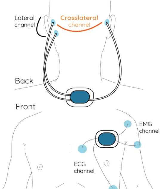 Figure 1 for Multimodal wearable EEG, EMG and accelerometry measurements improve the accuracy of tonic-clonic seizure detection in-hospital