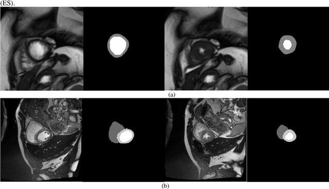 Figure 1 for An Improved Approach for Cardiac MRI Segmentation based on 3D UNet Combined with Papillary Muscle Exclusion