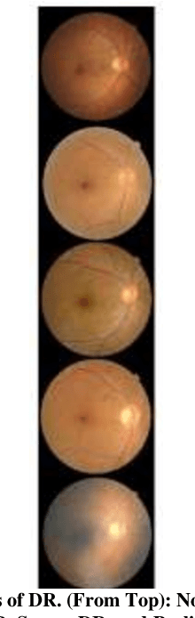 Figure 1 for Enhancing Diabetic Retinopathy Detection with CNN-Based Models: A Comparative Study of UNET and Stacked UNET Architectures