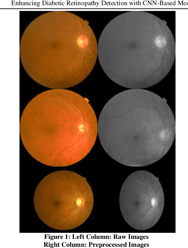 Figure 2 for Enhancing Diabetic Retinopathy Detection with CNN-Based Models: A Comparative Study of UNET and Stacked UNET Architectures