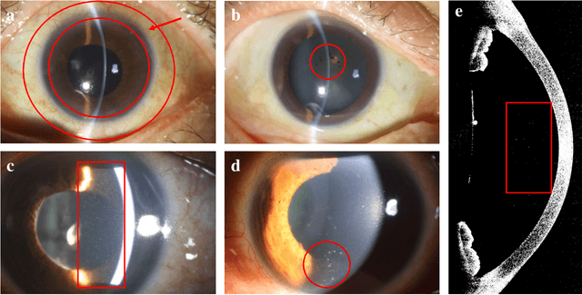 Figure 1 for Jointly Explicit and Implicit Cross-Modal Interaction Network for Anterior Chamber Inflammation Diagnosis