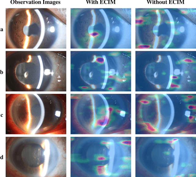 Figure 3 for Jointly Explicit and Implicit Cross-Modal Interaction Network for Anterior Chamber Inflammation Diagnosis