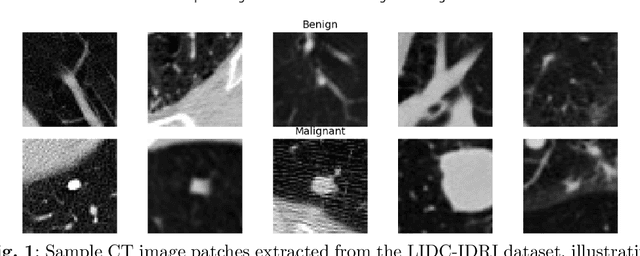 Figure 1 for Multi-Attention Stacked Ensemble for Lung Cancer Detection in CT Scans