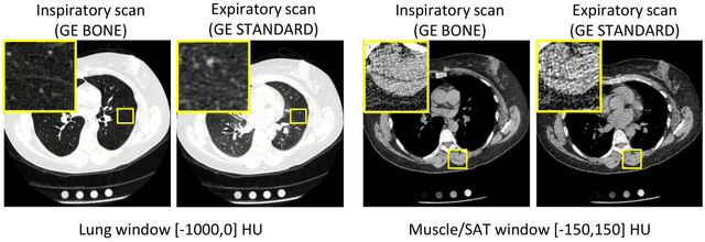 Figure 1 for Investigating the impact of kernel harmonization and deformable registration on inspiratory and expiratory chest CT images for people with COPD