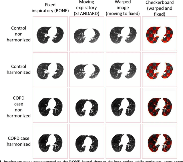 Figure 4 for Investigating the impact of kernel harmonization and deformable registration on inspiratory and expiratory chest CT images for people with COPD