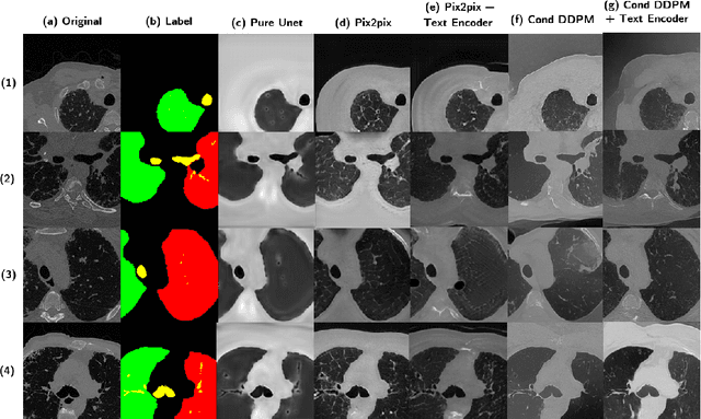 Figure 4 for Deep Generative Models Unveil Patterns in Medical Images Through Vision-Language Conditioning