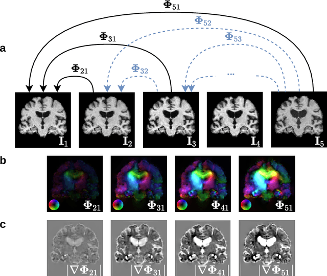 Figure 1 for MUSTER: Longitudinal Deformable Registration by Composition of Consecutive Deformations