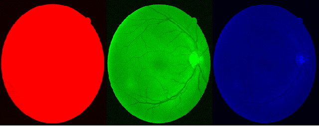 Figure 3 for A Novel Retinial Image Contrast Enhancement -- Fuzzy-Based Method