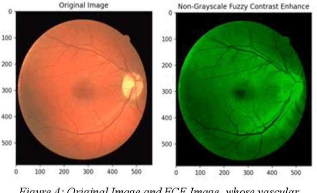 Figure 4 for A Novel Retinial Image Contrast Enhancement -- Fuzzy-Based Method