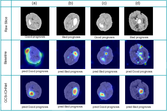 Figure 3 for GCS-ICHNet: Assessment of Intracerebral Hemorrhage Prognosis using Self-Attention with Domain Knowledge Integration