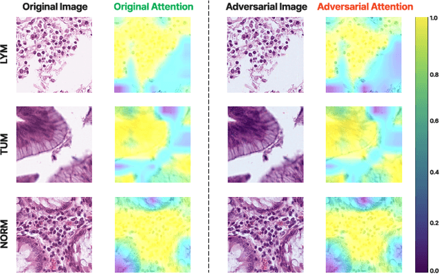 Figure 4 for Vulnerabilities Unveiled: Adversarially Attacking a Multimodal Vision Language Model for Pathology Imaging