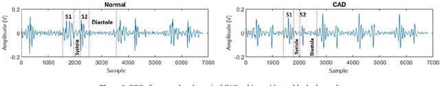 Figure 1 for Practicality meets precision: Wearable vest with integrated multi-channel PCG sensors for effective coronary artery disease pre-screening