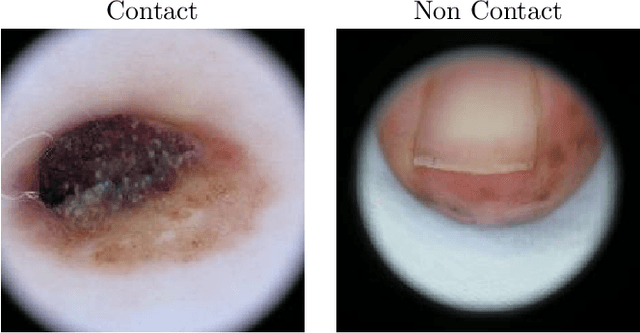 Figure 1 for Dermoscopic Dark Corner Artifacts Removal: Friend or Foe?