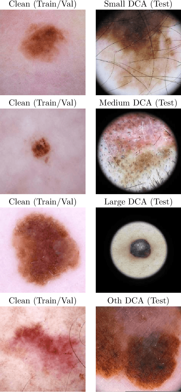 Figure 3 for Dermoscopic Dark Corner Artifacts Removal: Friend or Foe?