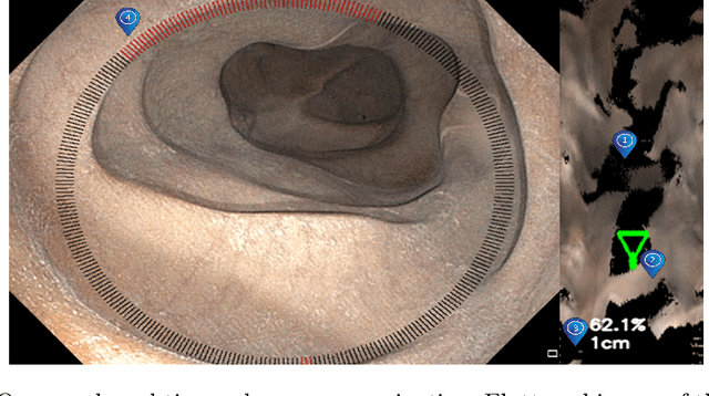 Figure 1 for ColNav: Real-Time Colon Navigation for Colonoscopy