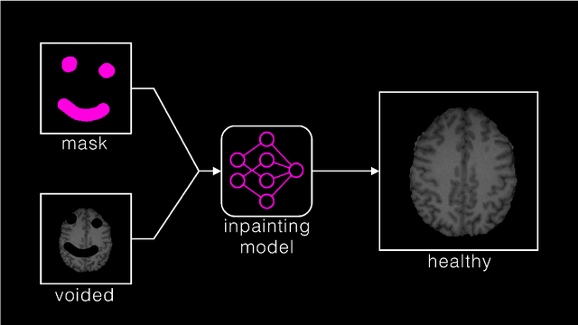 Figure 1 for The Brain Tumor Segmentation  Challenge 2023: Local Synthesis of Healthy Brain Tissue via Inpainting