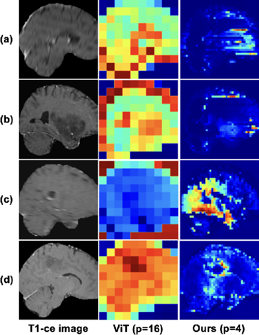 Figure 4 for Learning Brain Tumor Representation in 3D High-Resolution MR Images via Interpretable State Space Models