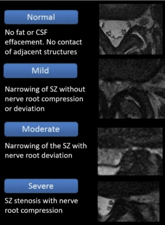 Figure 3 for Hybrid Convolution Neural Network Integrated with Pseudo-Newton Boosting for Lumbar Spine Degeneration Detection
