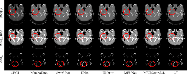 Figure 3 for GLFC: Unified Global-Local Feature and Contrast Learning with Mamba-Enhanced UNet for Synthetic CT Generation from CBCT