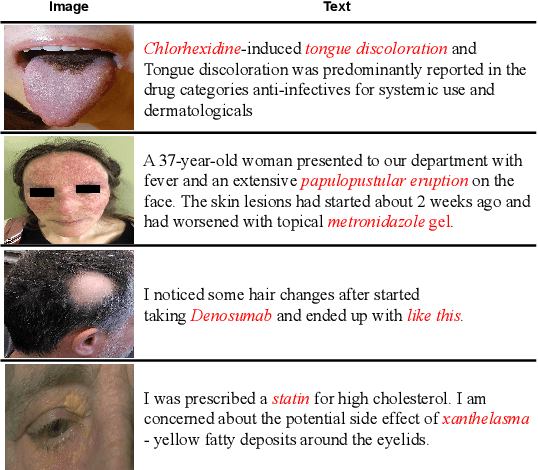 Figure 3 for Enhancing Adverse Drug Event Detection with Multimodal Dataset: Corpus Creation and Model Development