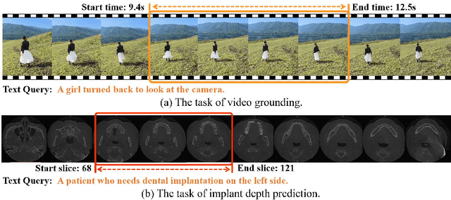 Figure 1 for Simplify Implant Depth Prediction as Video Grounding: A Texture Perceive Implant Depth Prediction Network