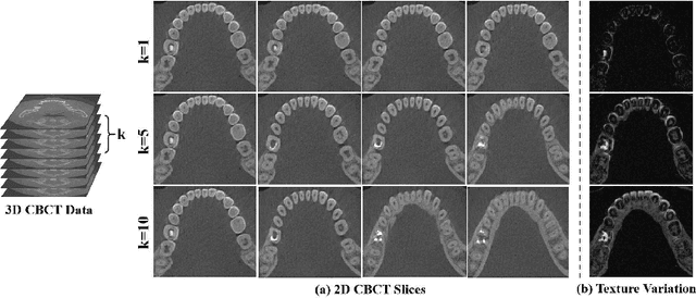 Figure 3 for Simplify Implant Depth Prediction as Video Grounding: A Texture Perceive Implant Depth Prediction Network