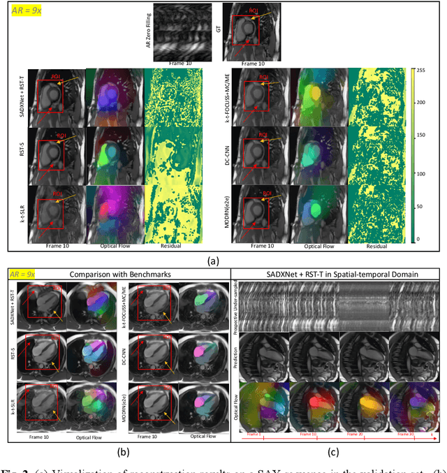 Figure 3 for Learning Dynamic MRI Reconstruction with Convolutional Network Assisted Reconstruction Swin Transformer