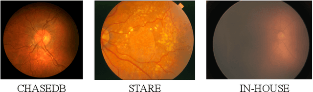 Figure 1 for Adversarial Vessel-Unveiling Semi-Supervised Segmentation for Retinopathy of Prematurity Diagnosis