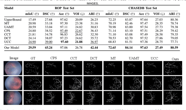 Figure 4 for Adversarial Vessel-Unveiling Semi-Supervised Segmentation for Retinopathy of Prematurity Diagnosis